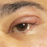 Inflamed eye with infected stye, upper eyelid, ophthalmic medicine.