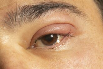 Inflamed eye with infected stye, upper eyelid, ophthalmic medicine.