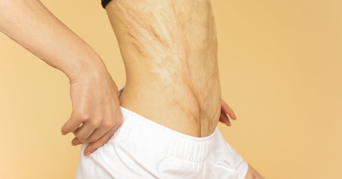 découvrez tout ce que vous devez savoir sur les vergetures : causes, prévention et traitements. obtenez des conseils pour prendre soin de votre peau et améliorer son apparence.