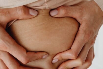 découvrez les causes, les traitements et les conseils pour atténuer les vergetures. apprenez à prendre soin de votre peau et à améliorer son apparence avec nos astuces et solutions efficaces.